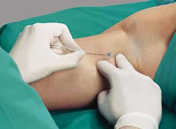 Hrotová elektroda pro přesnou stimulaci nervu Lékař může podle osobních preferencí týkajících se vpichu a punkčních vlastností jehly volit mezi jehlami se seříznutím hrotu v