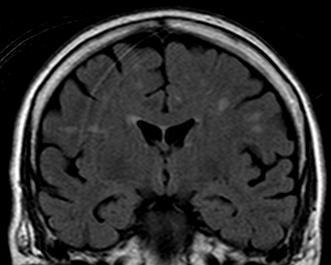 Soubor pacientů s TGA na neurologii SNO v r. 2016 + kazuistika recid. 25 (F15 / M10), 47-79 let 41-50(1), 51-60(6), 61-70(9), 71-80(9) F, E.Z., r. 41, HTN, 3x TGA v letech 2011, 14, 16 neurotop.