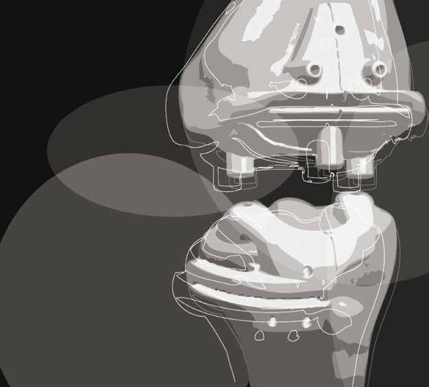 VISIONAIRE TECHNOLOGIE S POTENCIÁLEM ZLEPŠIT KLINICKÉ VÝSLEDKY TEP KOLENNÍHO KLOUBU I PROVOZNÍ EFEKTIVITU VÝHODY TECHNOLOGIE VISIONAIRE Méně operačních kroků (přibližně o 20 méně oproti standardnímu