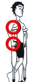 Správná výška berlí Podpažní berle uchopíme berle za rukojeti horní část je 2-3 cm pod pažemi, při stoji se lehce dotýkají podpažních jamek rukojeti jsou v horní části stehna, úroveň boků ohyb v