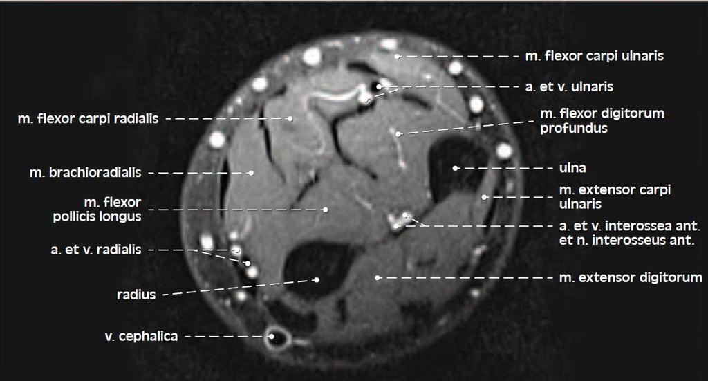 Transversální řez předloktím, MRI Grim,