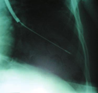 Podobný nález lze vidět i u PET/CT (Obr.