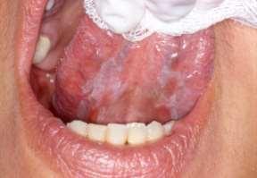 - Obtížné žvýkání vede k poruchám polykání sousta, vedoucí k postupnému hubnutí a sešlosti. - Zápach z úst je typický pro velké, špinavě povleklé, rozbředlé léze.