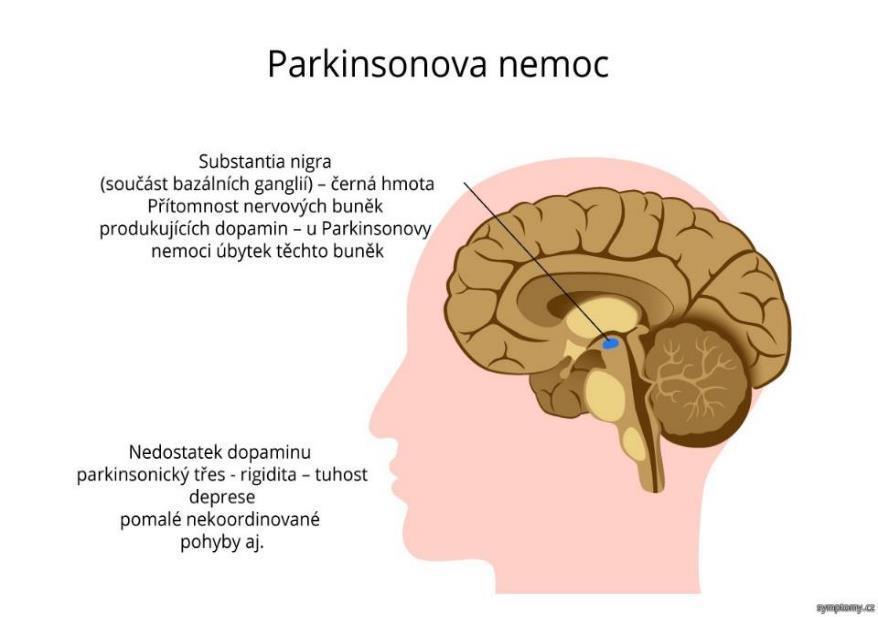 LEWYHO TĚLÍSKA Následek mutace -synucleinového génu -synuclein inhibuje apoptosu Jsou v astrocytech u