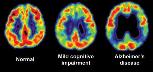 PET scan