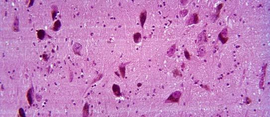 vedlejší produkt tvorby neurotransmiterů (monoaminy) Ztráta pigmentovaných