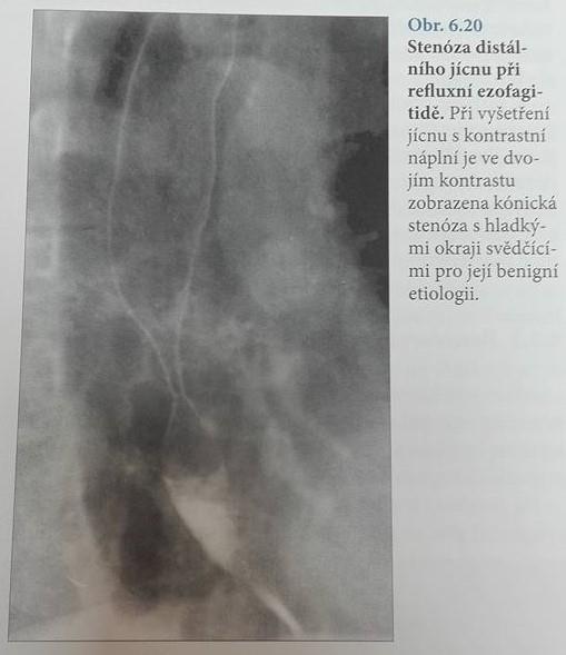 Mezi nejčastější symptomatologie patří: - pyróza ("pálení žáhy"; pálení za sternem pohybující se od epigastria k manubriu sterna, nejčastěji po jídle) - regurgitace šťáv (vtékání žaludečního obsahu