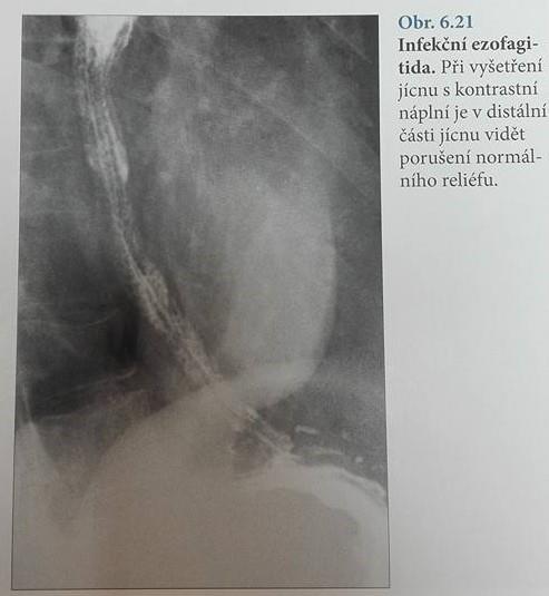 2.3 LÉKY INDUKOVANÁ EZOFAGITIDA Vzniká na podkladě lokálního působení užívaných léků, která jsou nedostatečně zapíjena a užívána vleže.