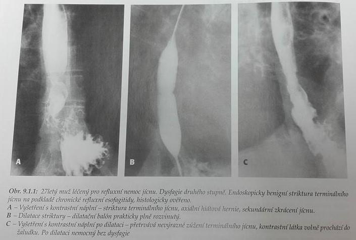 Délka a šíře balónku se samozřejmě liší. Dilatace striktury na 15-20 mm zajistí polykání potravy bez dysfagie. Z tohoto důvodu se používají k dilataci balónky o průměru 20 mm.