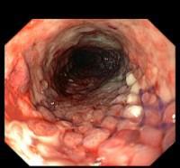 2 IMPLANTACE STENTU Benigní striktury jícnu rezistentní na dilataci jsou léčeny implantací jícnových stentů.