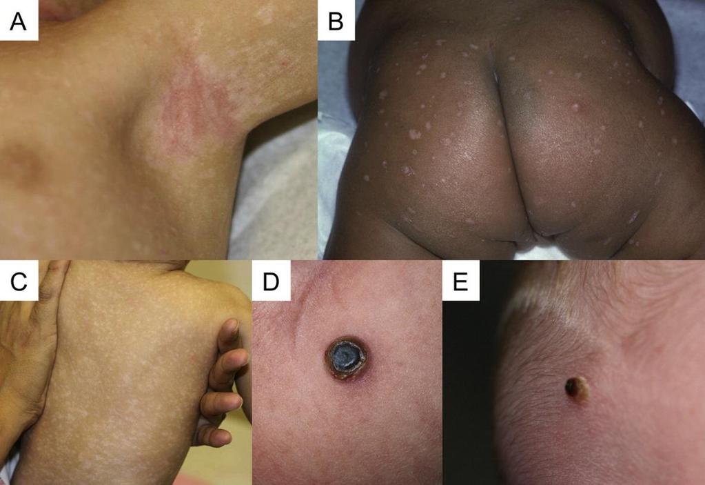 Obrázek 11: Kůže při onemocnění histiocytózou má proměnlivý vzhled. (A) Ekzematózní dermatitida. (B) a (C) Hypopigmentované makuly. (D) a (E) Chrupavčité papule.