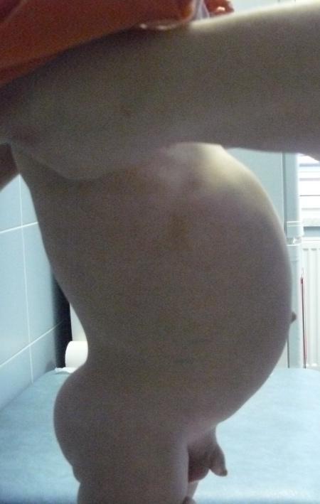 hepatoblastomem