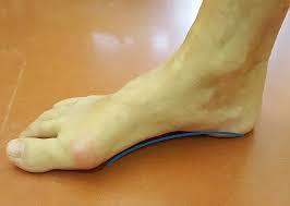 Vady nohou PES PLANUS podélně plochá noha - Pokles vnitřní klenby nožní.