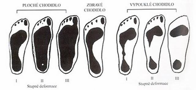 Vady nohou 3 STUPNĚ: 1. stupěň - pokles klenby někdy s valgózním postavením paty, deformitu lze aktivně korigovat, nejsou bolesti. 2.