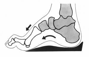 Vady nohou PES CAVUS lukovitá noha - Abnormálně zvýšená podélná nožní klenba, spojená se zkrácením měkkých tkání plosky nohy.