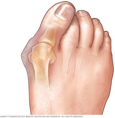 Vady nohou HALLUX VALGUS vbočený palec - Nejčastější získaná deformita nohy. - Komplexní postižení přednoží s poruchou postavení palce.