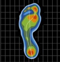 Individuálně vyráběné ortopedické vložky vložky digimed - digitální baropodometrie - Digitální