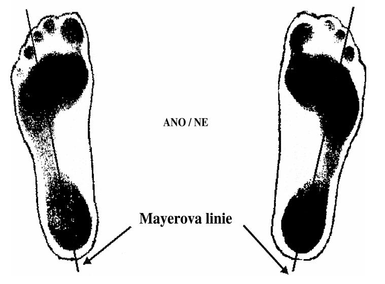 Obr. 6 Hodnocení podle Mayera (Riegerová, 2006) Hodnocení metodou segmentů (obr. 7) Tato metoda je používána pro svoji názornost při hodnocení rozsahu oploštění nohy. Základem měření je určení tzv.