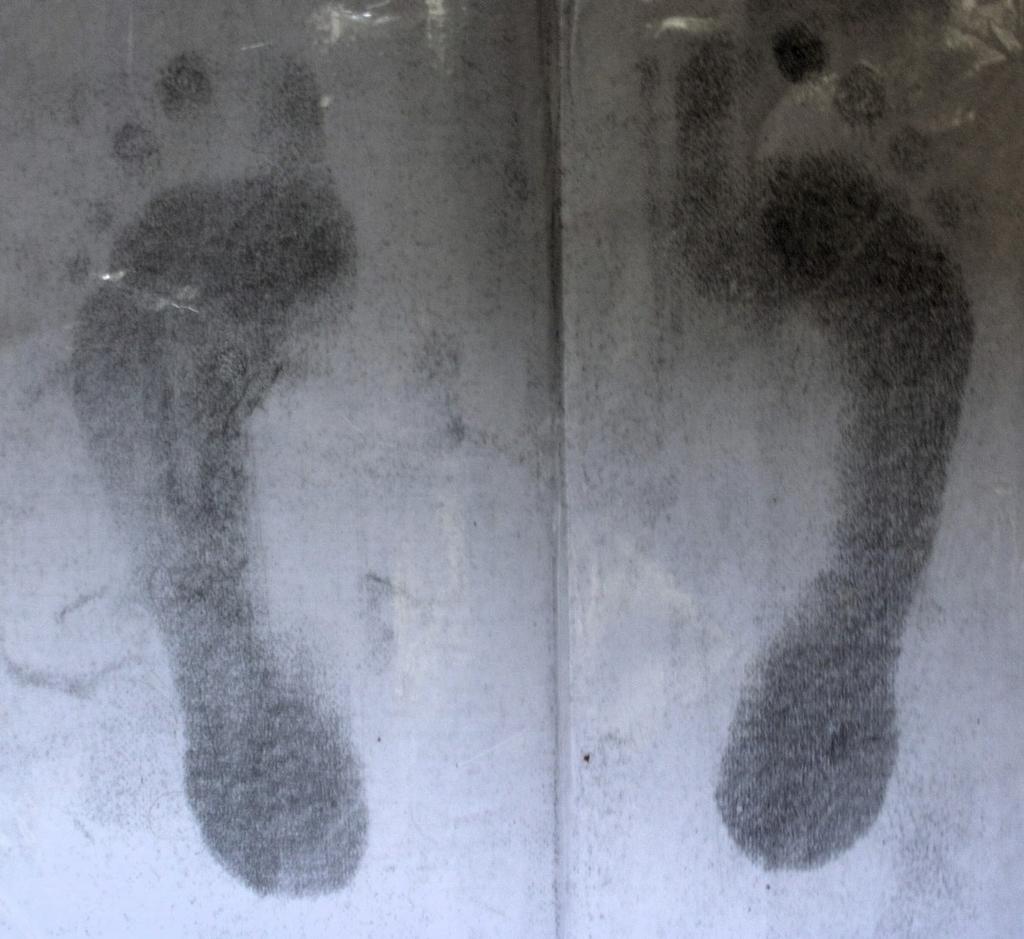 dorzoplantární pohyb MTP kloubů omezen omezený posun os cuboideum a os naviculare dorzoplantárně, os calcaneus mediolaterálně oboustranně pohyblivost hlavičky fibuly bez omezení na obou DK omezená