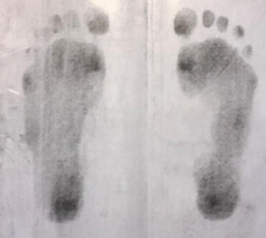Vyšetření zkrácených svalů Tabulka 15 Zkrácené svaly DKK (Pacient 4) Neurologické vyšetření Pacientka je orientována místem, časem i prostorem. Výsledky vyšetření fyziologické.