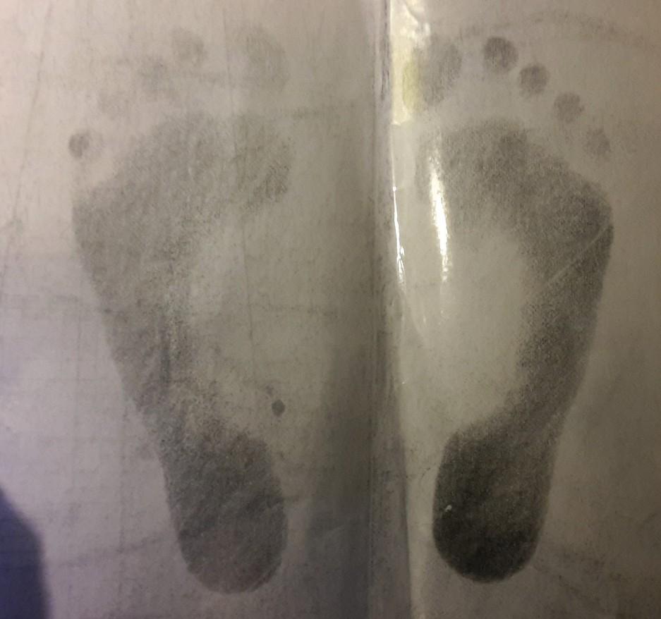 6.1.3 Výstupní hodnocení pacient 3 pacientka méně vtáčí špičky zlepšení rozložení váhy na dvou vahách 32 kg x 35 kg zvětšení rozsahu pohybů do inverze a everze na levé noze; zvětšen rozsah flexe v