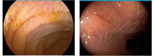 1.3 PATOFYZIOLOGIE Vliv v patogenezi celiakie mají geny umístěné na šestém chromozomu HLA DQ1 *0501 a DQB1 *0201.