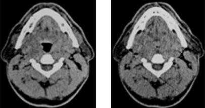 15 Sagitální řez MRI faryngu, (a) bez OSAS, (b) s OSAS (zdroj Dr.