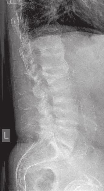 Mírná spondylóza ventrálního a laterálního typu v rozsahu L2 L5. Obr. 2 (vpravo) RTG páteře 07/2013 popis: Kompresivní fraktura L2 má charakter až platyspondylie. Prolomená horní krycí plocha L4.