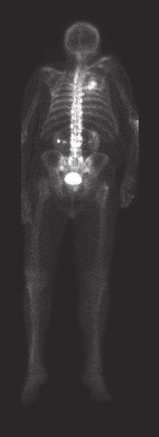žebra vpravo a manubria sterni (obr. 3) (diagnóza 02/2015 scintigrafie skeletu), 02/2015 byla zahájena terapie antiandrogenem (bikalutamid).