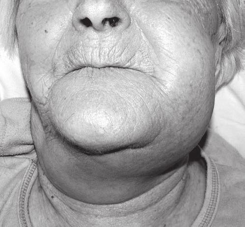1 Osteonekróza maxilly 45letý muž s generalizovaným karcinomem ledviny, vznik po extrakci zubů bez preventivních opatření, rizikové léky do vzniku