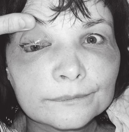2 Osteonekróza mandibuly 57letý muž s generalizovaným karcinomem ledviny, vznik po extrakci zubů bez preventivních opatření, rizikové léky do vzniku