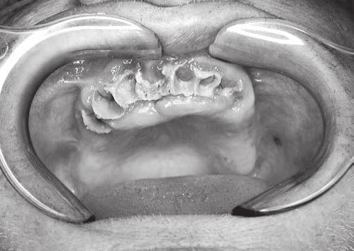PŘEHLEDOVÝ ČLÁNEK vační oblasti nervus alveolaris inferior (Vincentův příznak), případně nervus infraorbitalis, související s poškozením těchto nervových struktur.