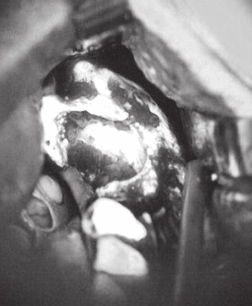 PŘEHLEDOVÝ ČLÁNEK Obr. 14, 15 Vyšetření přístrojem VELscope u bisfosfonátové osteonekrózy mandibuly.