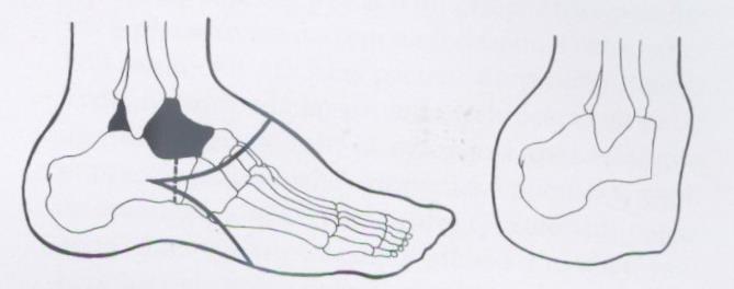 Amputace podle Choparta: Jedná se o oddělení nožní části v kostním skloubení talonavikularní a kalkaneokuboidní. (Sosna, 2001) Amputace podle Pirogova: Jedná se o značně technicky komplikovaný výkon.