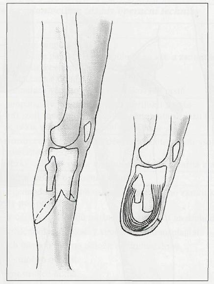 4.6 Amputace pod kolenem (transtibiální) Jedná se o častý typ amputace se zachováním dobré funkce pahýlu. Dochází k přetětí tibie a fibuly v potřebné výšce a překrytí svalovou tkání.