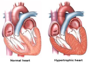 KARDIOMYOPATIE KOČEK Nejčastěji diagnostikované onemocnění srdce u koček je HCM HCM je