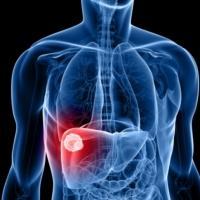 Steatóza pečene Prítomnosť nadmerného množstva tuku v pečeni ako súčasť metabolického syndrómu.