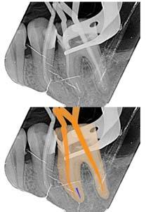 Obr. 7: Intraorální rentgenový snímek po ukončení endodontického ošetření a dostavby jader zubů v rámci přípravy na protetickou rekonstrukci korunek. Obr.
