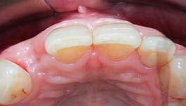 44 Odborné zkušenosti LKS 2/2018 Tipy k dosažení kvalitního výsledku červené estetiky kolem zubního implantátu Aleš Váňa AV dental, s. r. o., Praha O autorovi MUDr. Aleš Váňa promoval v r.