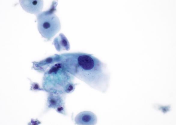 Obr.10 Cytologický obraz LG SIL. U lehké dysplazie lze pozorovat zvýšený NC poměr (40 % v uvedené buňce), hyperchromní chromatin, který je taktéž hrubší než u normálních buněk. (www.eurocytology.