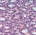 to answer the following questions: Is it normal or diseased? Is it BPH or cancer?
