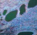 But this method suffers from considerable inter- and intra- observer variability, i.e. it is a subjective process.