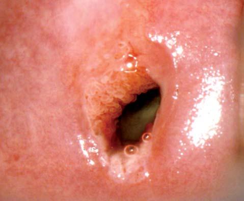 Ektopie jako rizikový faktor HPV infekce děložního hrdla a cíl primárně preventivních opatření MUDr.