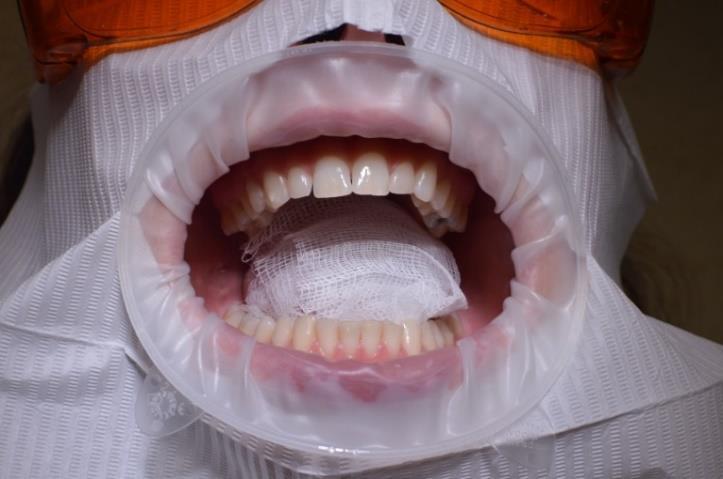 dochází k poškození zubní skloviny postupnou mikroabrazí, avšak zuby po očištění vždy leštíme (Marušanová, 2014). Indikace bikarbonátu sodného Obrázek č.