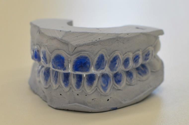 Zuby určené k bělení zaznamenáme do laboratorního štítku, jejich počet je individuální.