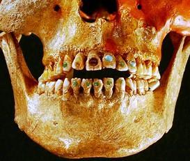 3.4. DENTÁLNÍ ŠPERK Pokud mluvíme o dentálním šperku, jedná se o kamínky nebo jiné ozdůbky, které jsou připevněny na povrchu zubu.