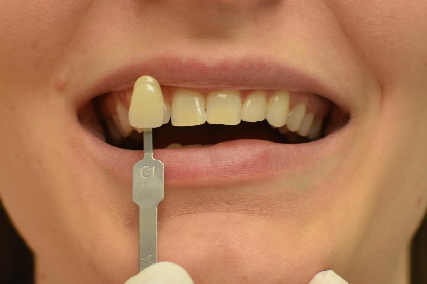 Estetické výkony v ordinaci dentální hygienistky Esthetic Procedures at the  Dental Hygienist s Office - PDF Free Download