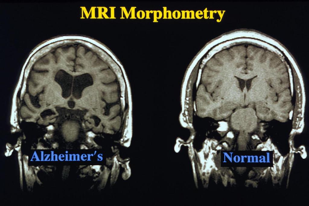 MRI mozku M.