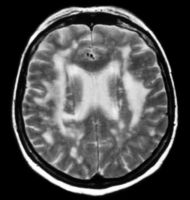 Vaskulární demence Neuropsychologicky dysexekutivní syndrom zpomalení++++ Porucha