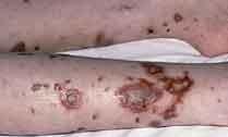 10 http://www.infektionsbiologie.ch (pokračování) Aţ tehdy se nechala odvézt do nemocnice na infekční oddělení. V sanitce upadla do bezvědomí a lékaři konstatovali rozvrat metabolismu.